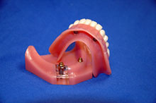 Ball Denture